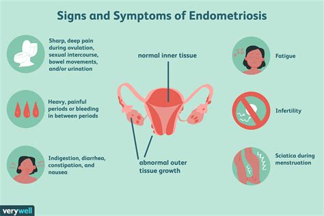 what are the symptoms of endometriosis